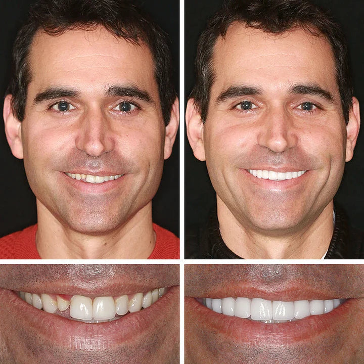 💖Ends Today: 75% OFF! ⏰Pryxo™  Medical Full Denture with Strong Suctiond Custom-Fit Full Functional Dentures🦷Obtain American Dental Association (ADA) Certification