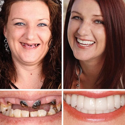 🌎Ends Today: 70% OFF! ⏰ Custom-Fit Full Functional Dentures| Smile with Confidence