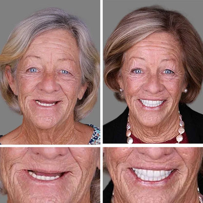 💖Ends Today: 75% OFF! ⏰Pryxo™  Medical Full Denture with Strong Suctiond Custom-Fit Full Functional Dentures🦷Obtain American Dental Association (ADA) Certification
