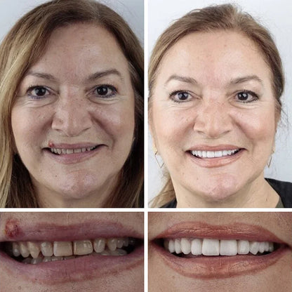 💖Ends Today: 75% OFF! ⏰Pryxo™  Medical Full Denture with Strong Suctiond Custom-Fit Full Functional Dentures🦷Obtain American Dental Association (ADA) Certification