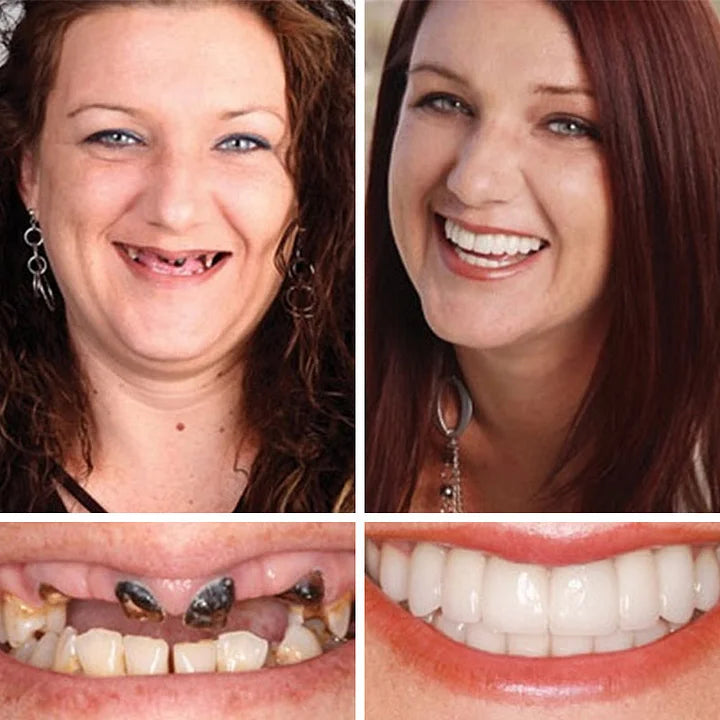 💖Ends Today: 75% OFF! ⏰Pryxo™  Medical Full Denture with Strong Suctiond Custom-Fit Full Functional Dentures🦷Obtain American Dental Association (ADA) Certification