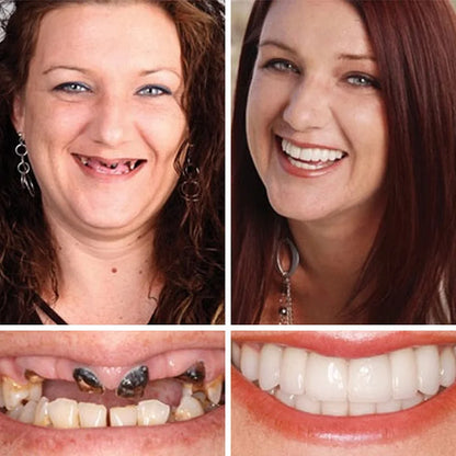 💖Ends Today: 75% OFF! ⏰Pryxo™  Medical Full Denture with Strong Suctiond Custom-Fit Full Functional Dentures🦷Obtain American Dental Association (ADA) Certification